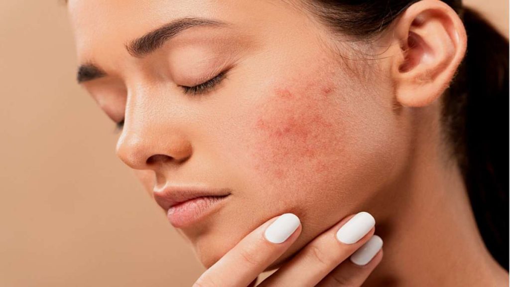 How To Remove Pimples Naturally at Home